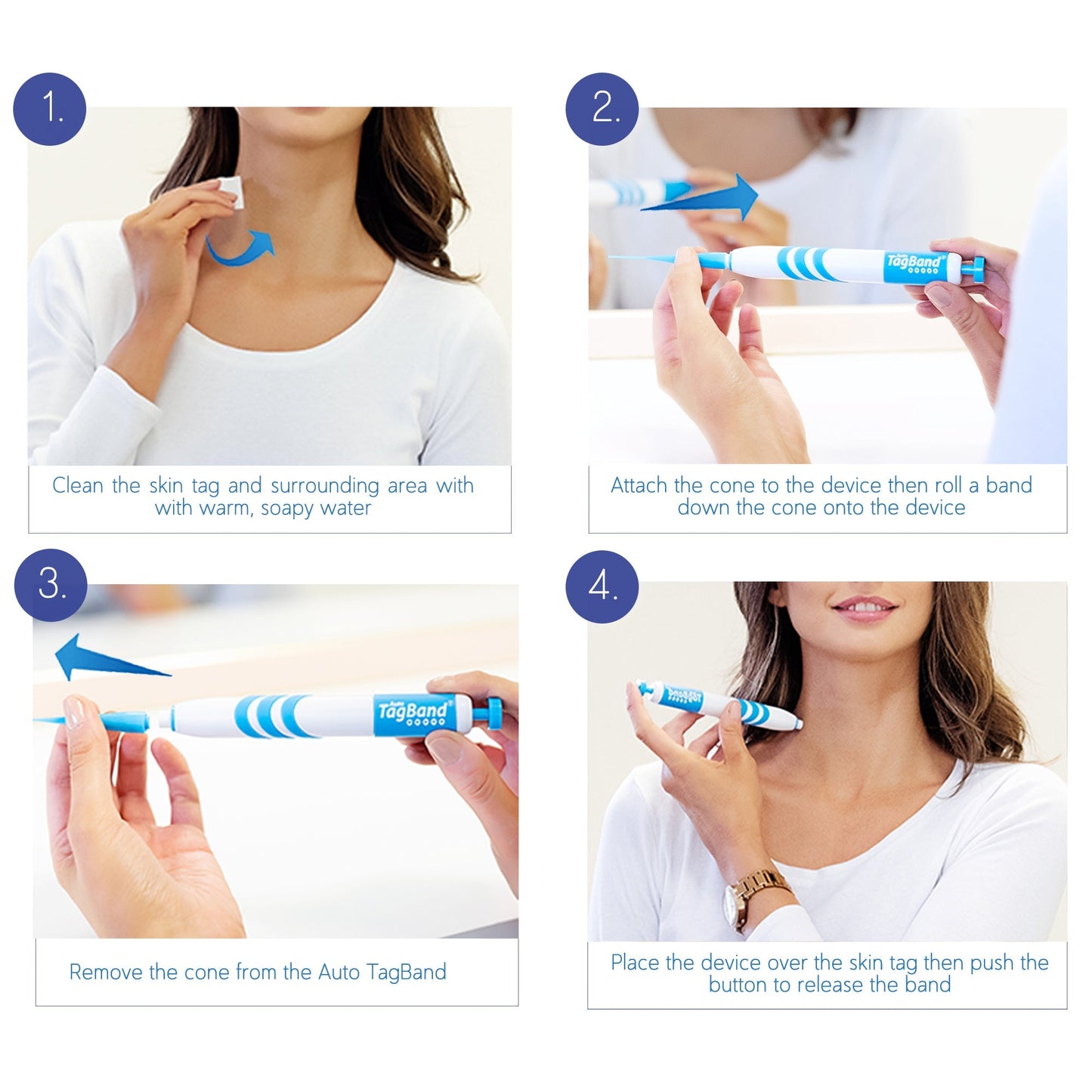 TagBand Easy Skin Tag Remover