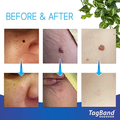 TagBand Skin Tag Remover Kit